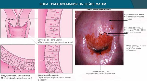 Как выглядит эктропион шейки матки