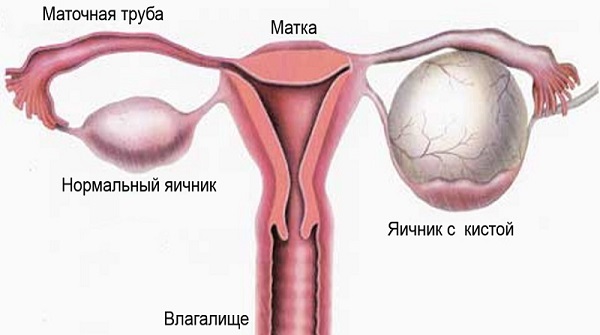 Фото, как выглядит киста яичника