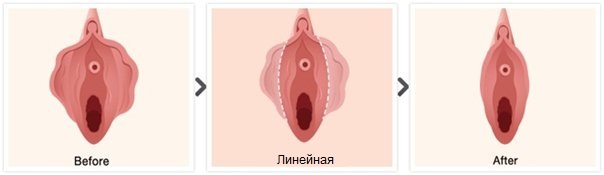 Линейная техника лабиопластики