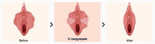 V-образная лабиопластика
