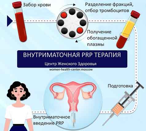 Этапы процедуры внутриматочной PRP