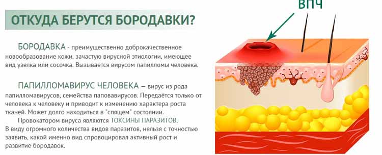 Причины роста бородавок
