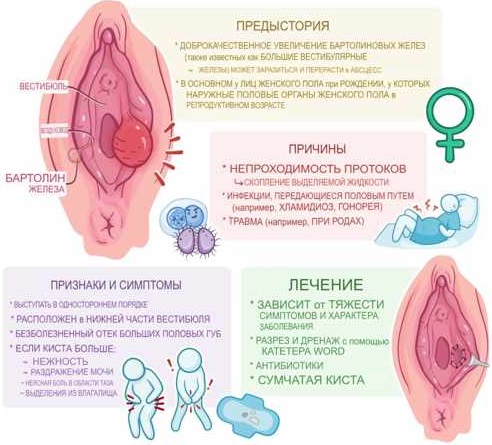 Как развивается киста Бартолиновых желез