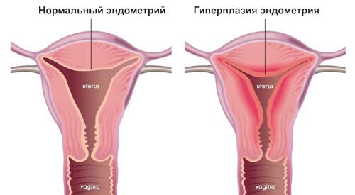 Как выглядит железистая гиперплазия эндометрия