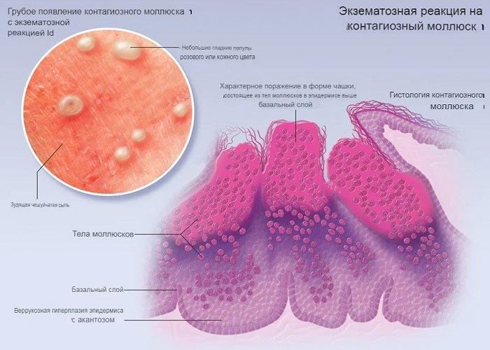 Схема строения контагиозного моллюска на половой губе