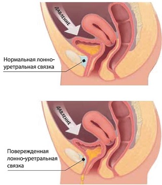 Схема, как развивается недержание мочи при нагрузке