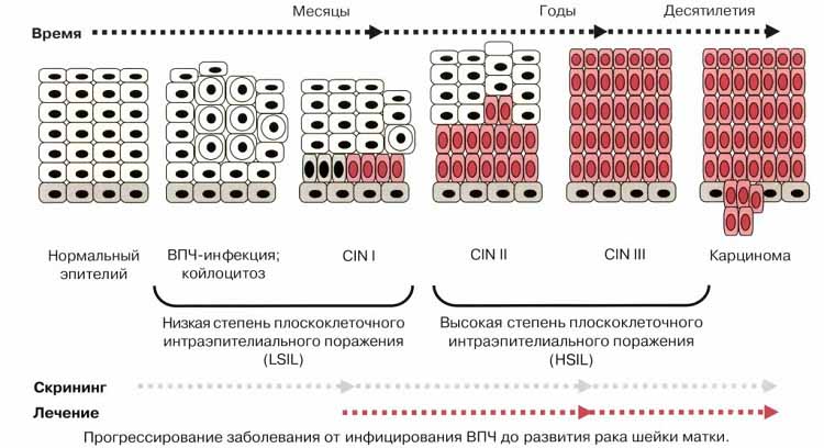 Схема прогрессирования ВПЧ