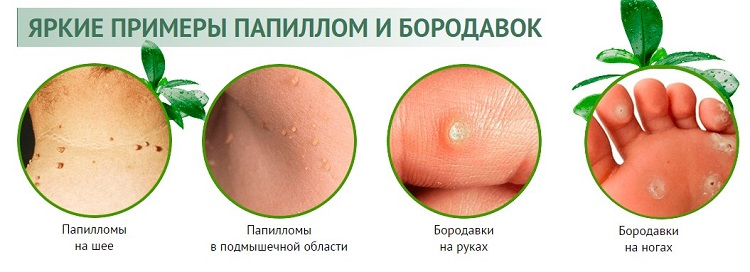 Как выглядят папилломы на теле женщины